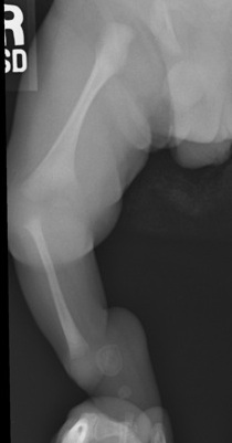 Tibial Hemimelia Complete